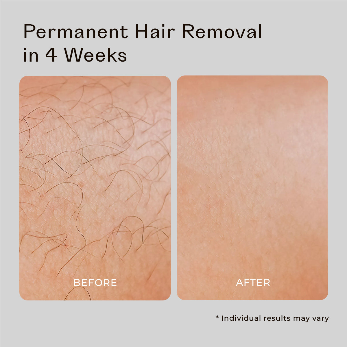 5MINSKIN AT-HOME LASER HAIR REMOVAL HANDSET - 50% OFF BLACK FRIDAY SALE