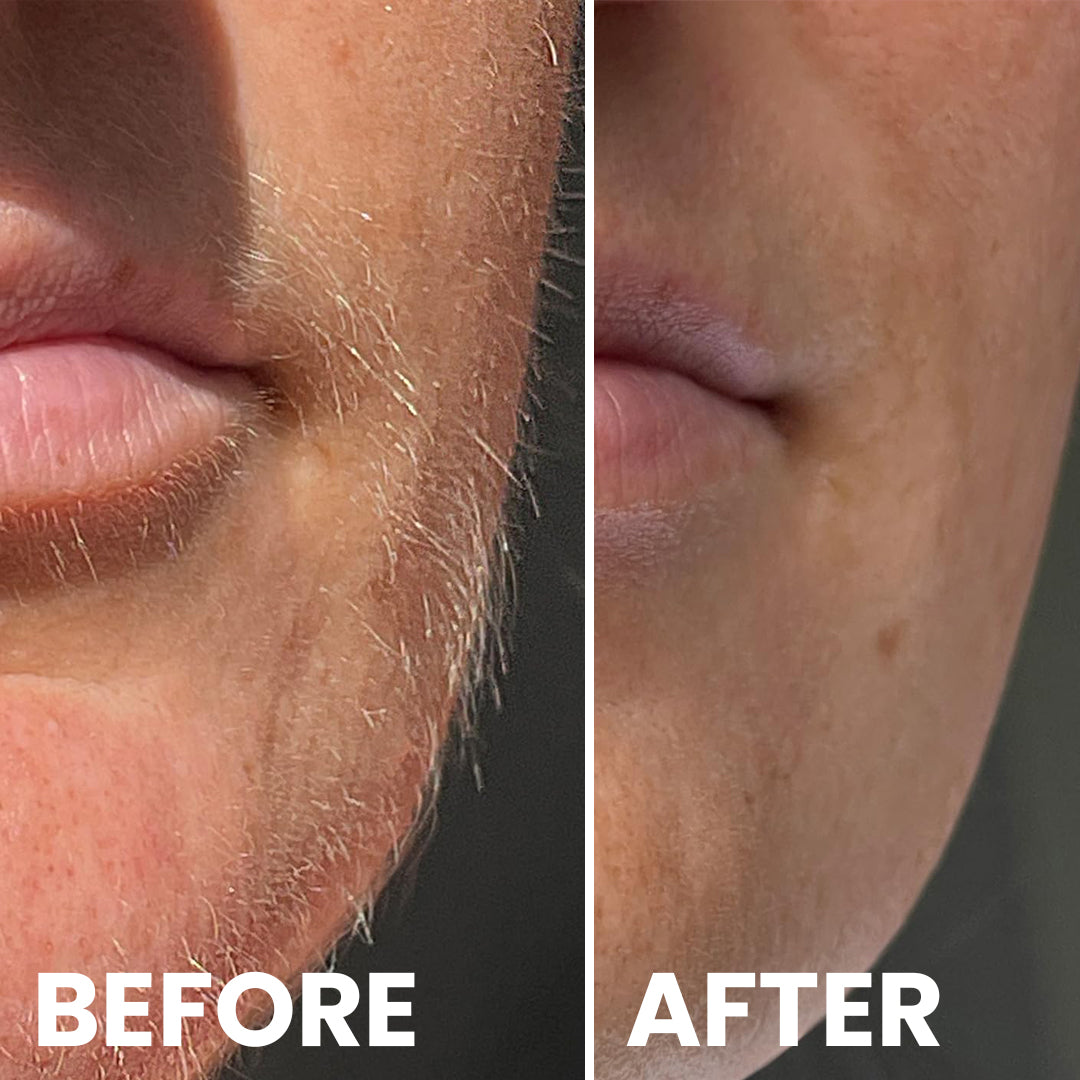 5MINSKIN AT-HOME LASER HAIR REMOVAL HANDSET - 72% OFF MOTHER'S DAY SALE + 4 FREE GIFTS (WORTH $290)