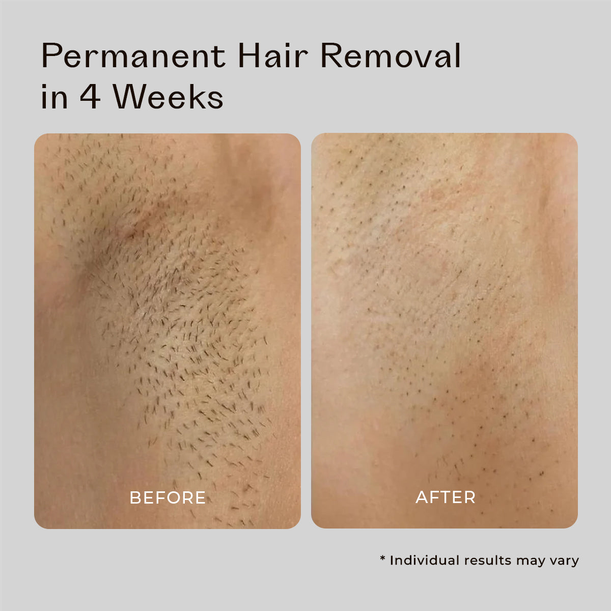 5MINSKIN AT-HOME LASER HAIR REMOVAL HANDSET - 50% OFF BLACK FRIDAY SALE