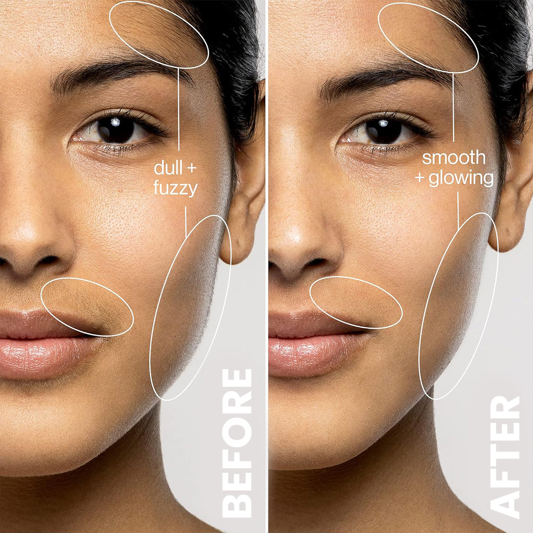 AURICULAR DE DEPILACIÓN LÁSER EN CASA 5MINSKIN