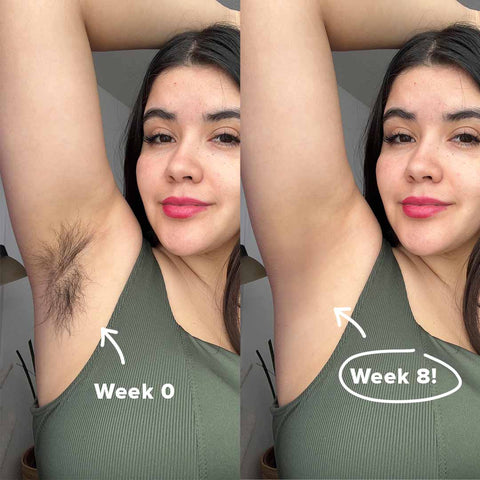 5MINSKIN-HAIR-ZAPPER-2.0 DISPOSITIVO-DE-DEPILACIÓN-LÁSER-EN-CASA